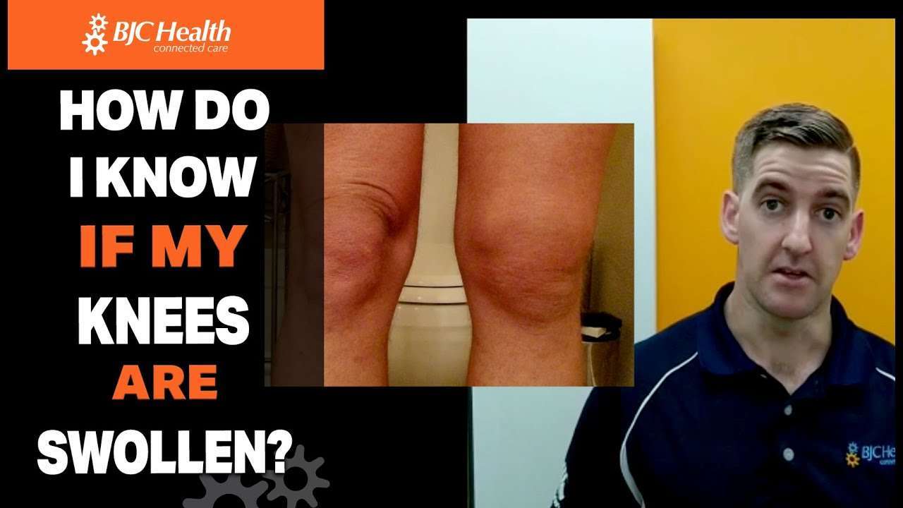 why-is-my-knee-still-swollen-knee-replacement-youtube